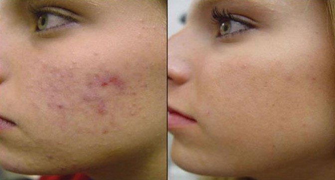 Natural Home Remedies For Pimples Overnight - Youme And Trends