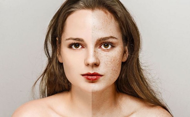How To Get Rid Of Freckles by home rememdies