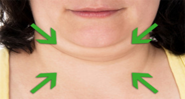 how to get rid of chin