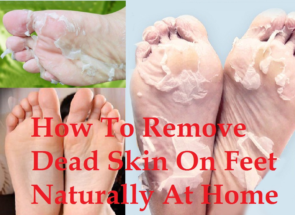home remedies to get rid of dead skin from foot