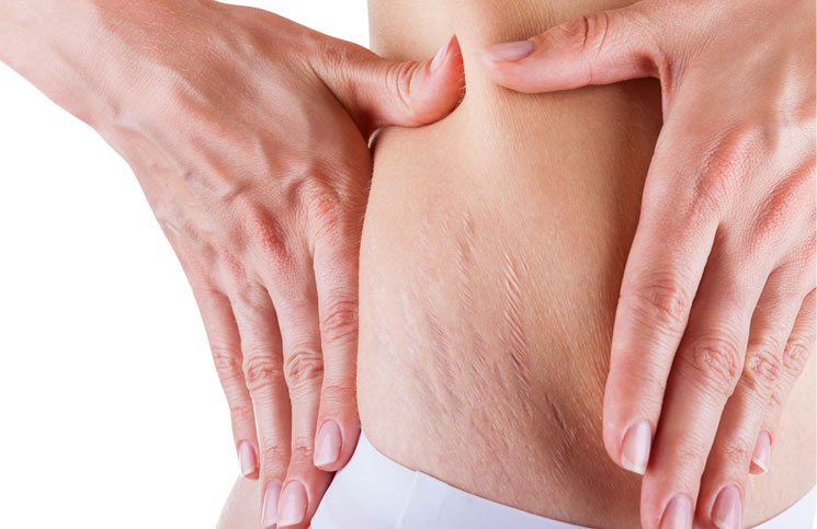 how to remove stretch marks 