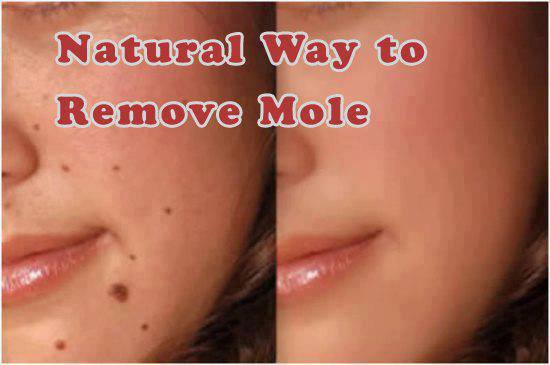 how to remove mole at home