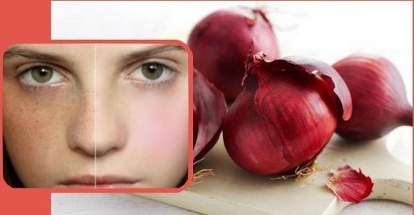 Onion To Get Rid Of Pigmentation