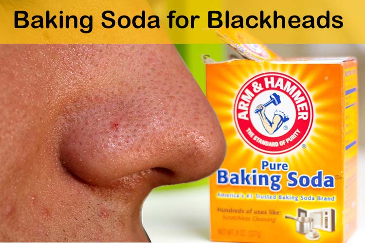 how to remove blackheads naturally
