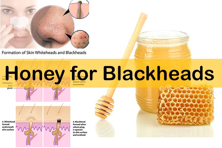 how to prevent blackheads on nose