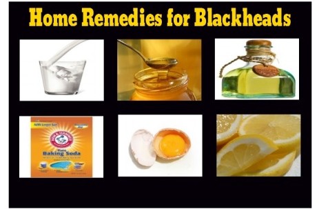 How to remove blackheads naturally