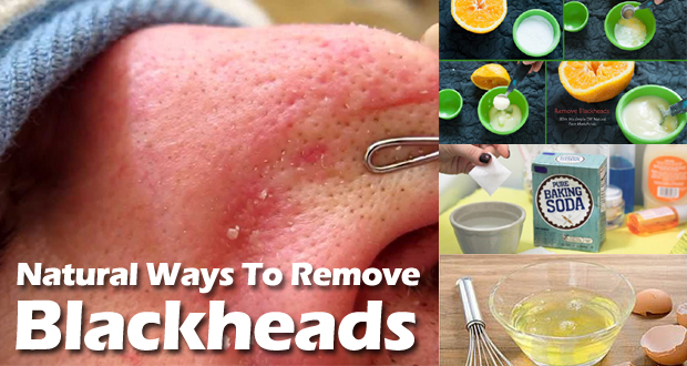 how to remove blackheads instantly