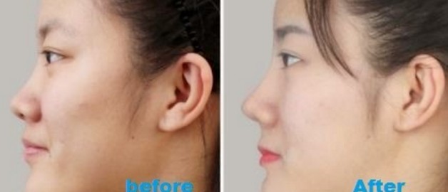 how to make smaller nose