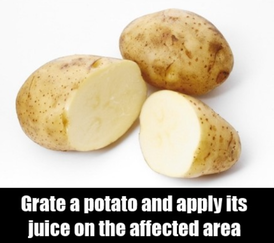 potatoes to get rid of pigmentation
