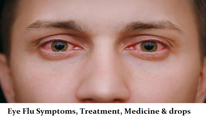 Eye Flu Symptoms, Treatment, Medicine & drops